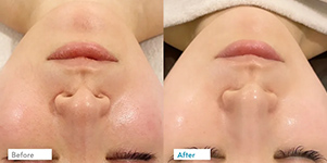 before after