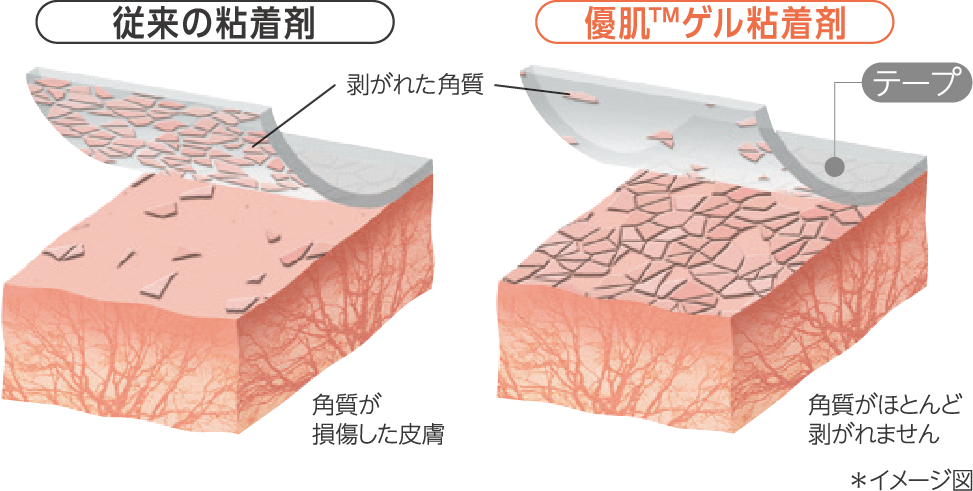 角質保護システム 優肌™ゲル粘着剤は、貼付・剥離による物理的な刺激(角質層の損傷)を抑えます。従来の粘着剤が貼り替え時に角質層まで剥離し、痛みやかぶれの原因となるのに対し、優肌™ゲル粘着剤は、軟らかく皮膚の凹凸になじみやすく、優しく剥離することができます。